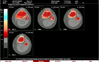 Surgical Removal of Patellar Tendon Ossicle