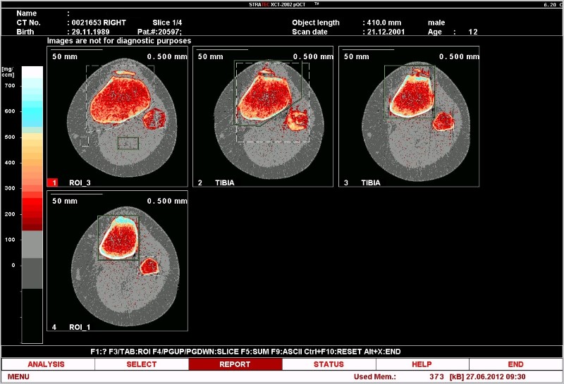 Surgical Removal of Patellar Tendon Ossicle