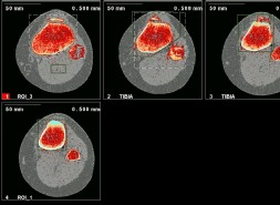 How to diagnose Osgood Schlatters Disease